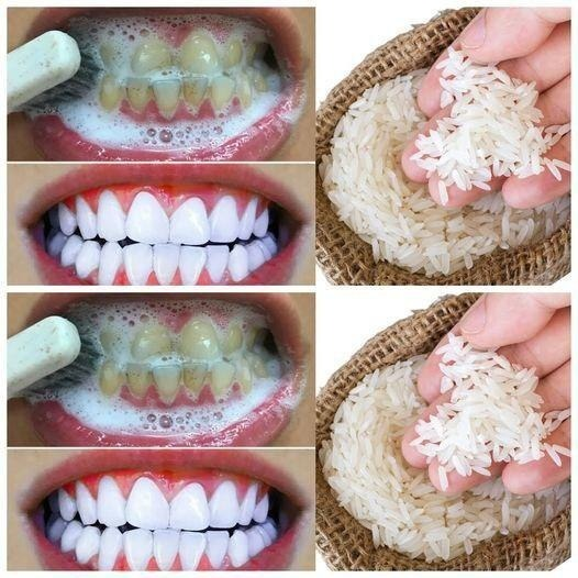 RAPID TEETH WHITENING in 1 minute