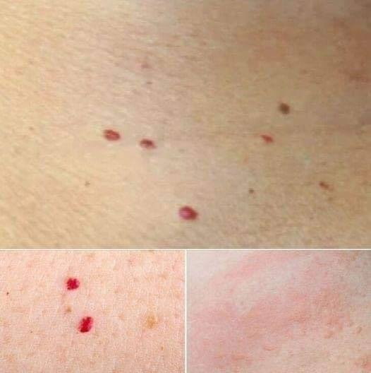 If you spot these red dots on your skin, here’s what they mean