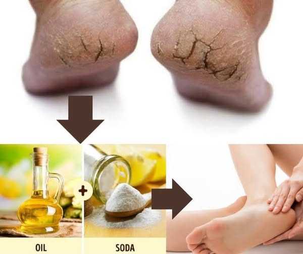 A Natural Remedy for Cracked Heels with Olive Oil and Baking Soda