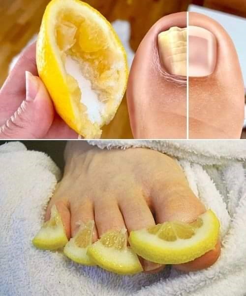 Lemon: A Natural Remedy for Combating Toenail Fungus