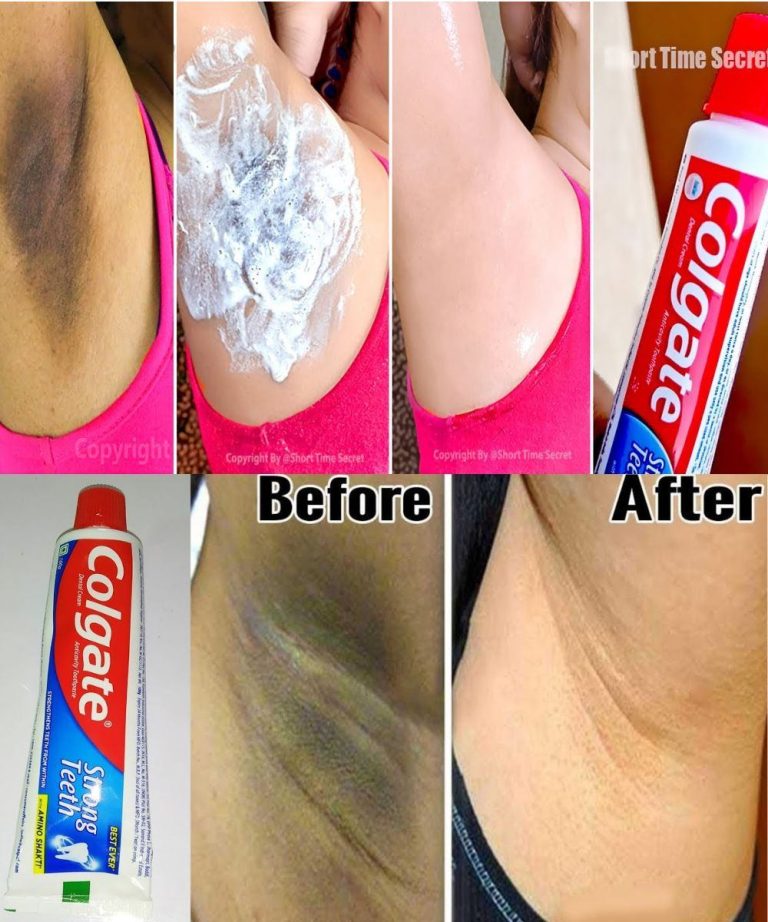 Brighten Dark Underarms with a Surprising Remedy: Toothpaste!