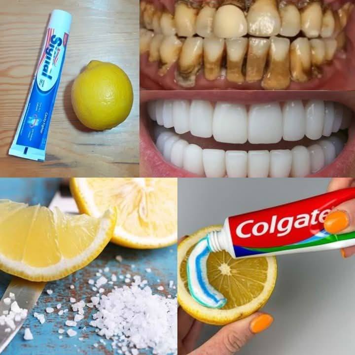 Natural mixture for yellow teeth whitening at home in one day without a dentist, a proven method