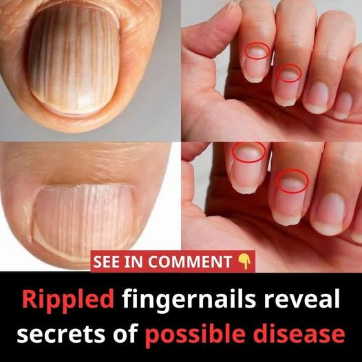 Rippled fingernails reveal secrets of possible disease