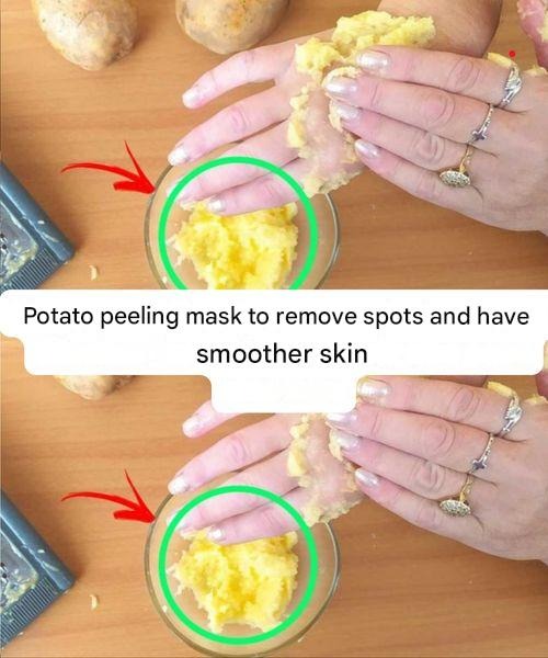 Potato peeling mask to remove blemishes and have a smoother skin