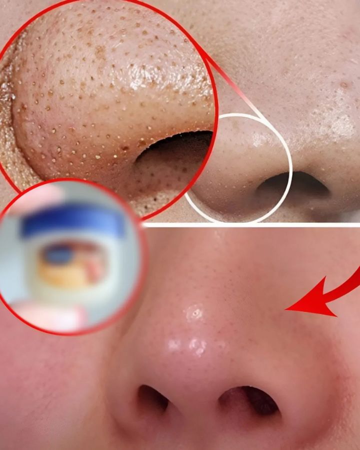 Remove blackheads on your nose