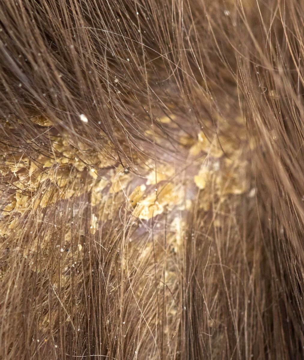 Something is causing flakes and itchiness on my scalp.