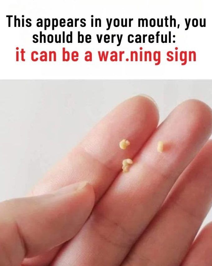 This appears in your mouth, you should be very careful: it can be a war.ning sign