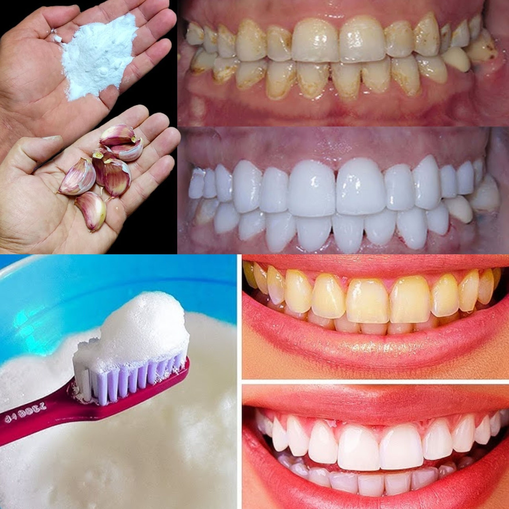 The Secret to Whitening Teeth in Just 2 Minutes! Shiny, Pearly Teeth with Garlic & Baking Soda – Natural and Effective!