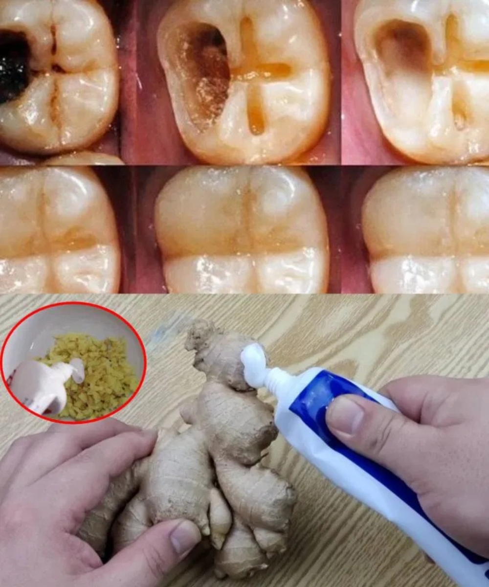How to Naturally Repair a Cavity & Strengthen Your Teeth