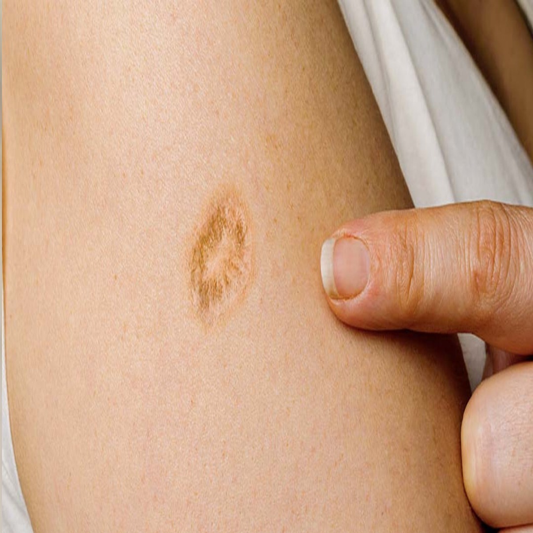Why do many people have a small scar on their left arm?