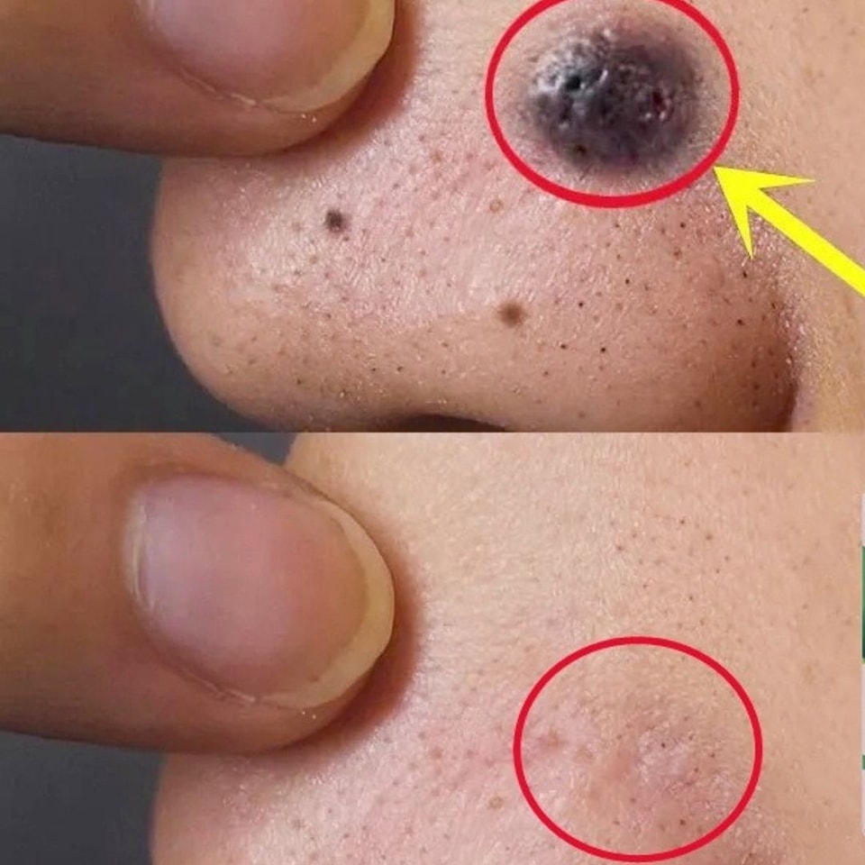 Eliminate Moles, Warts, Blackheads, Skin Tags, and Age Spots Naturally and Permanently