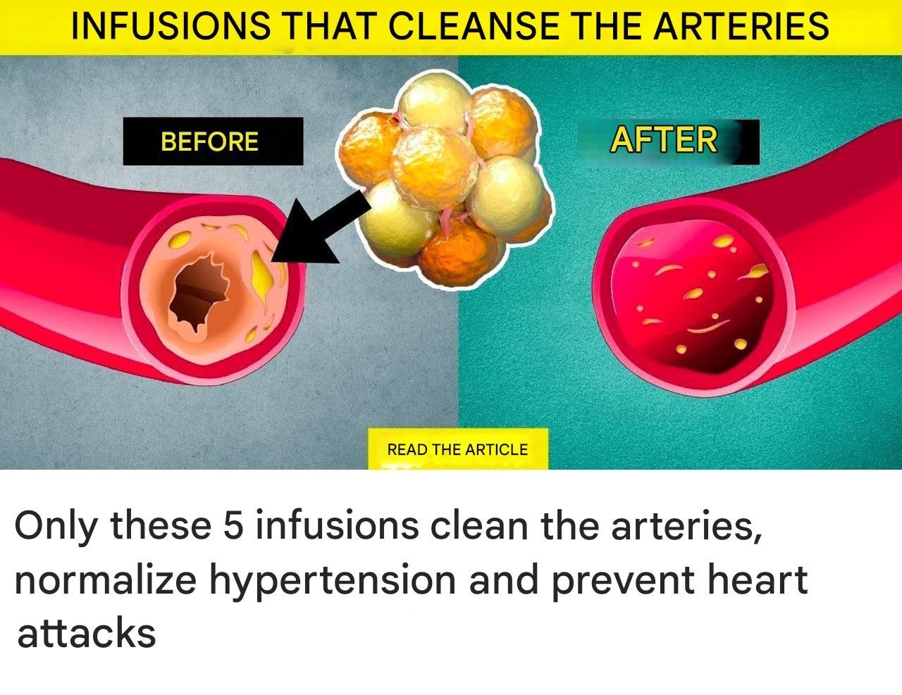 Only these 5 infusions clean the arteries, normalize hypertension and prevent heart attacks