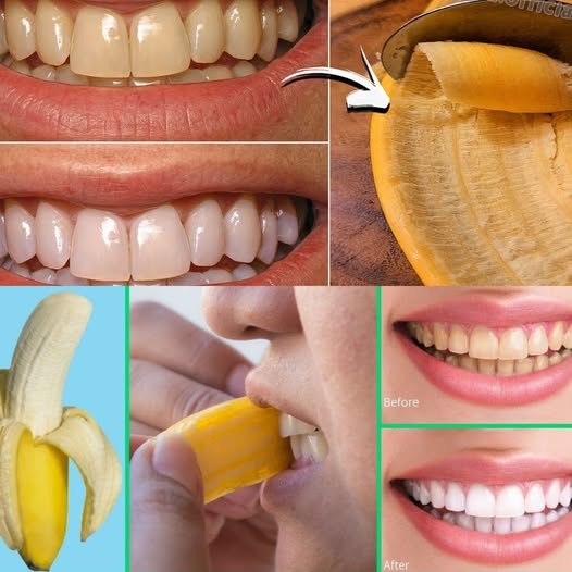 Easy & Natural Teeth Whitening with Banana Peels! 