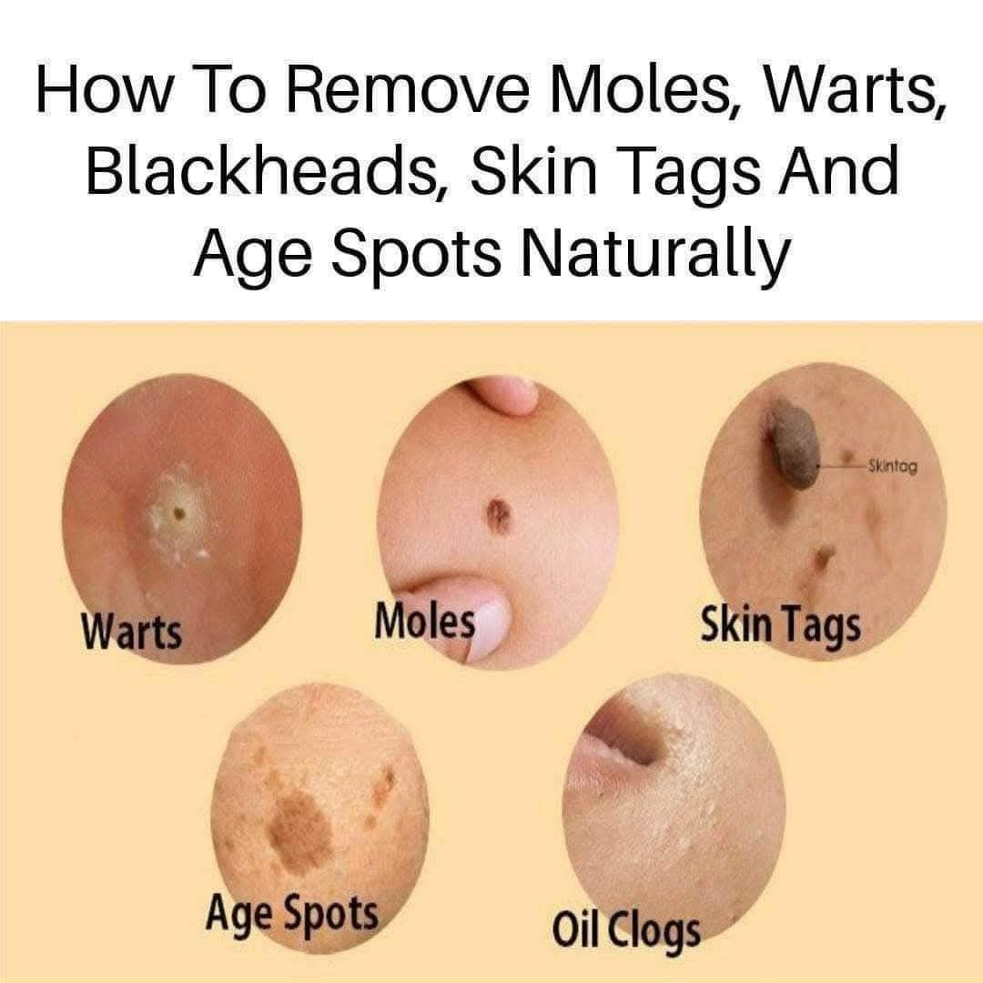 Natural Remedies for Age Spots, Moles, Skin Tags, Warts & Blackheads : Zero Stress, Zero Cost & Pro Tips for Monetization!