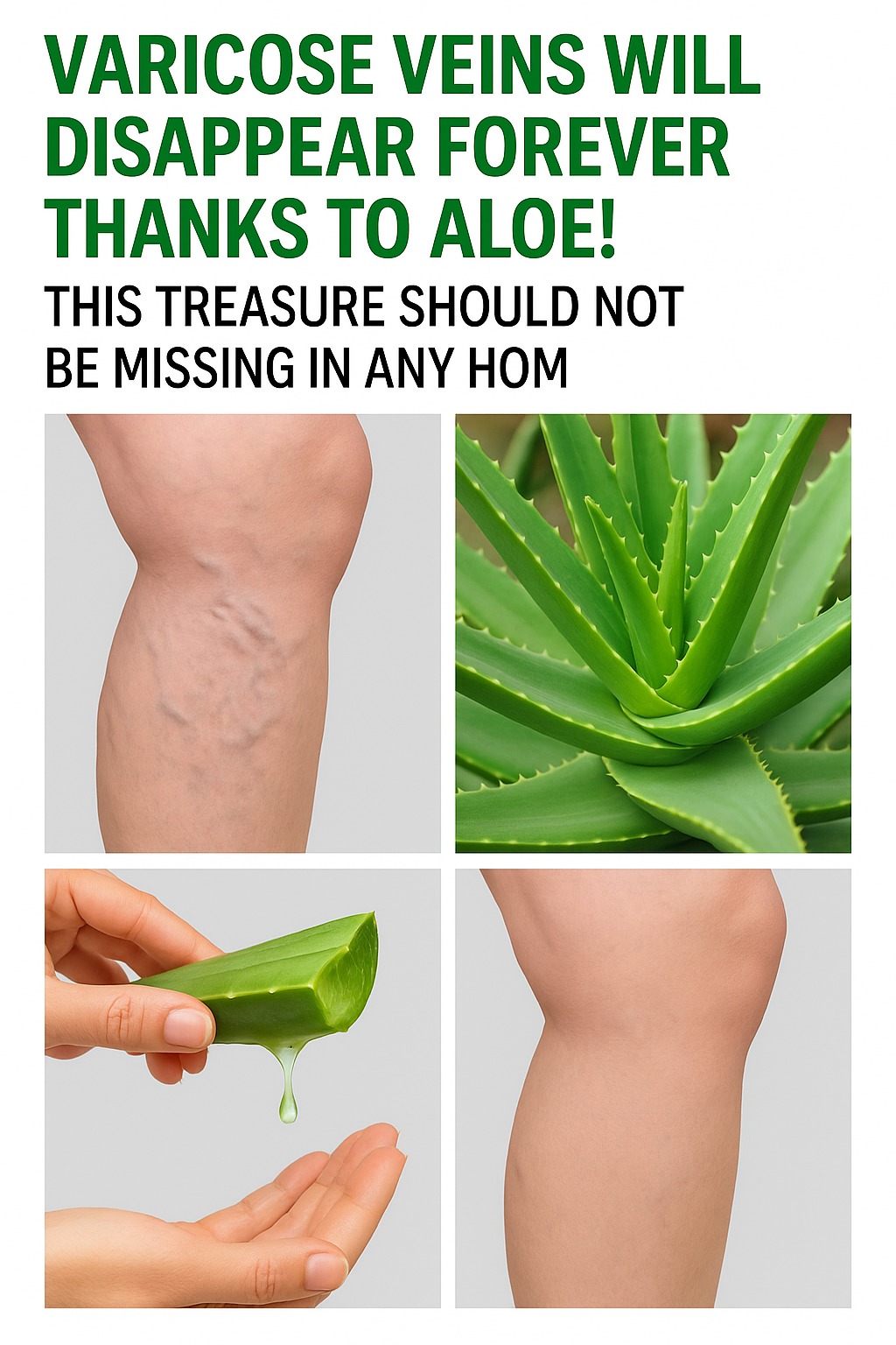 Aloe Vera: A Gentle Solution for Varicose Veins
